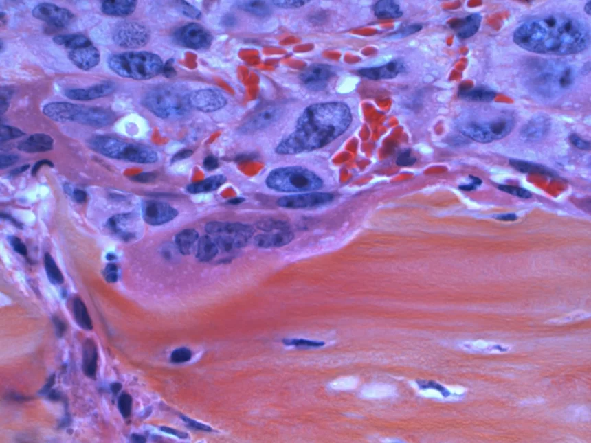 Colorectal Cancer